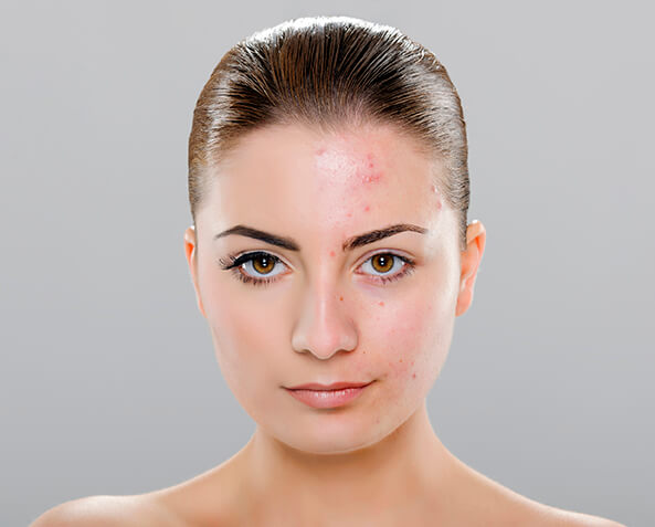 Žena s hnědými vlasy, polovina obličeje je bez akné, polovina má akné.